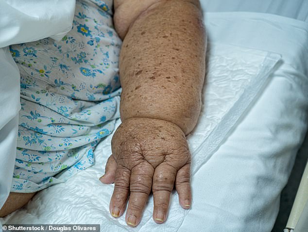 New study shows many breast cancer patients can skip surgery to avoid arm swelling.